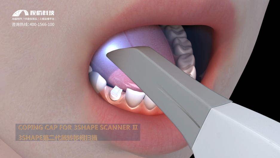 口腔種植技術(shù)動畫